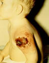This child died as a result of vaccines - pictures from the CDC about the side effects of vaccines